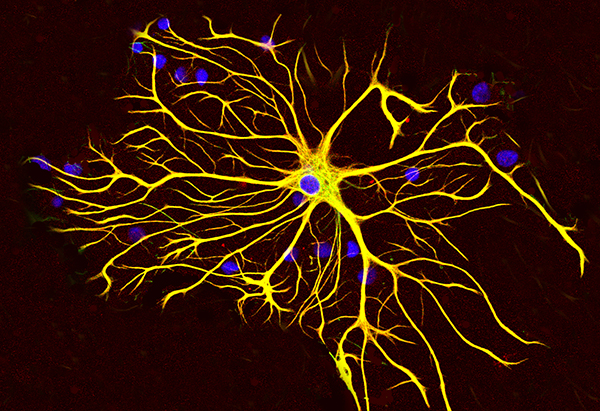 Researchers have succeeded in transforming human support brain cells, called astroglial cells, into functioning neurons for brain repair.The new technology opens the door to future development of drugs that patients could take as pills to regenerate neurons and to restore brain functions lost after traumatic injuries, stroke, or diseases such as Alzheimer’s. Previous research, such as conventional stem-cell therapy, has required brain surgery, so it is much more invasive and prone to immune-system rejection and other problems.