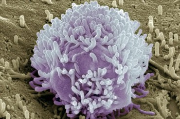 Scientists track 1st precise timeline of cancer in a patient